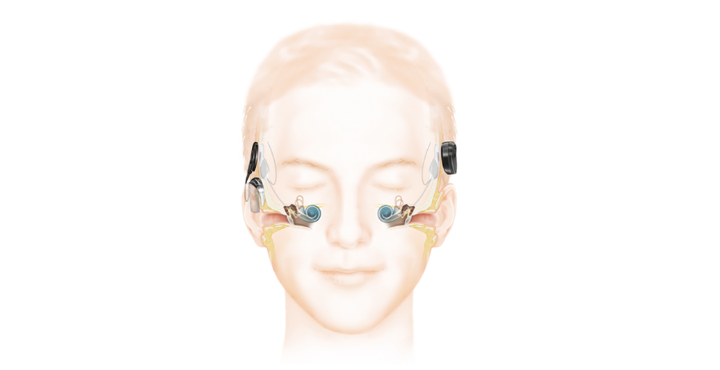 Skizze über die Funktionalität eines CI Implantats.